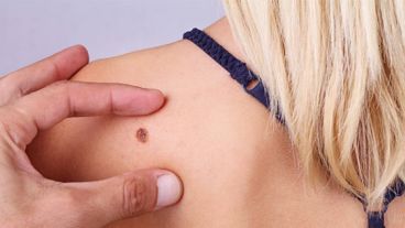 El melanoma cutáneo es un cáncer de piel agresivo, y el único cuyo pronóstico se determina según su grosor.