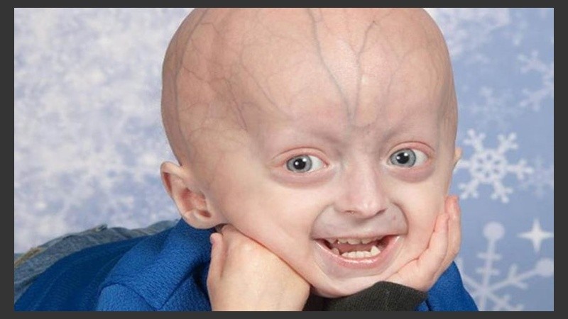 Con la progeria el envejecimiento se dispara y acelera cuando los afectados solo han cumplido su primer o segundo año de vida.