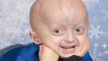 Con la progeria el envejecimiento se dispara y acelera cuando los afectados solo han cumplido su primer o segundo año de vida.