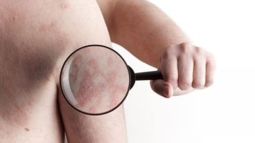 Una psoriasis mal controlada afecta enormemente la calidad de vida.