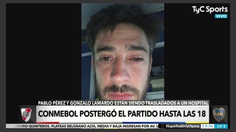 Así quedó el ojo izquierdo de Pérez.