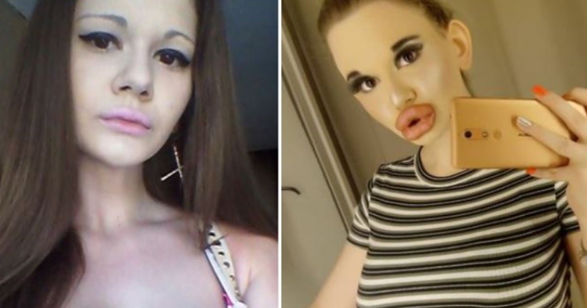 Fotos Mujer Con Los Labios Más Grandes Del Mundo Quiere Parecerse A Una Muñeca Bratz Rosario3 