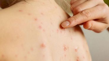 El sarampión es una enfermedad viral altamente contagiosa que puede provocar complicaciones mortales.