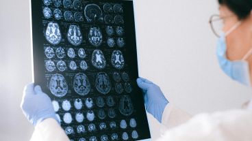 Actualmente, el Alzheimer afecta a más de 35 millones de personas en el mundo.