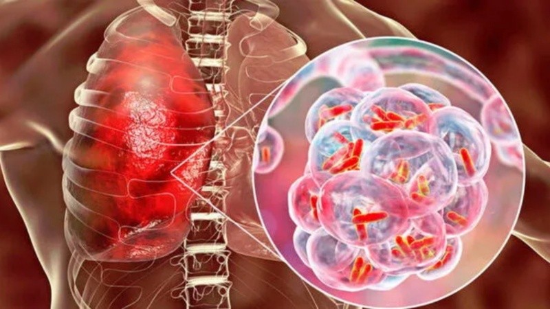 La prueba está destinada a pacientes que dan positivo en pruebas de detección de tuberculosis pulmonar y no iniciaron tratamiento, o recibieron menos de 3 días de tratamiento en los últimos 6 meses.